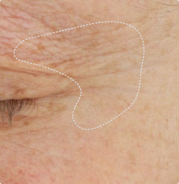 Skin texture at Week 0